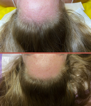 Tratamentgo alopecia Luana Ourique