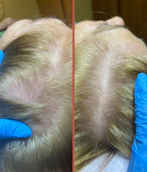 alopecia11