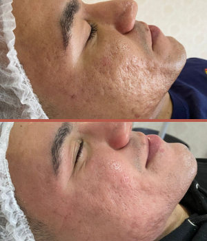 pele acne 222