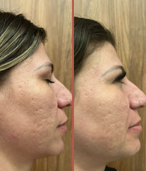 pele acne 2222