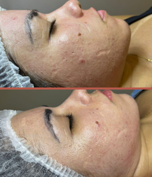 pele acne1111