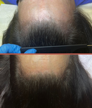 tratamento queda de cabelo Luana Ourique