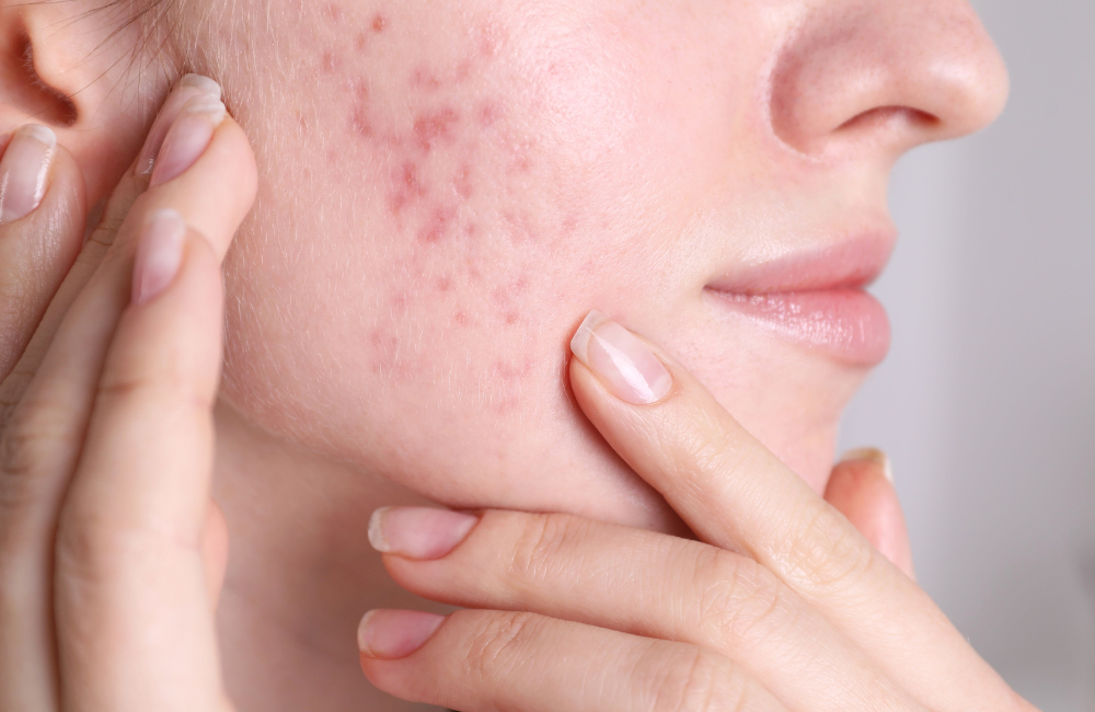 Tratamento para Cicatriz de Acne: Como Recuperar a Beleza e a Confiança da Sua Pele