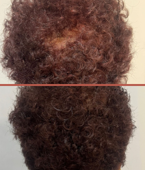 Alopecia Feminina
