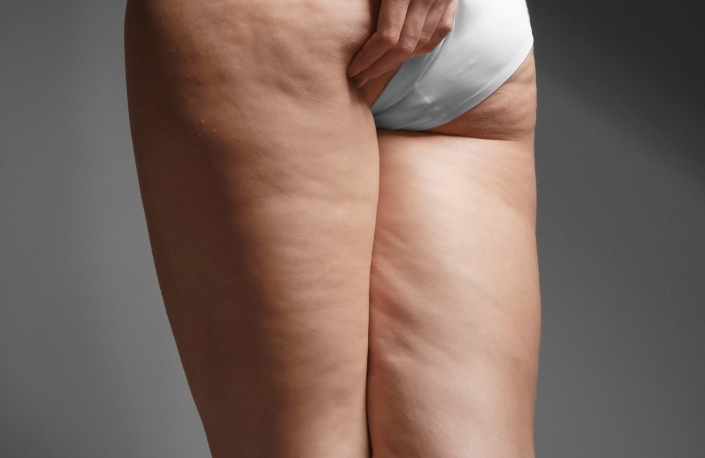 Lipedema - Olimpia