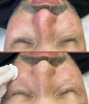 Tratamento acne