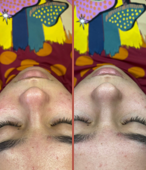 tratamento acne limpeza