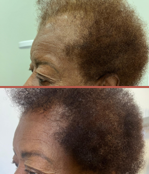 tratamento alopecia