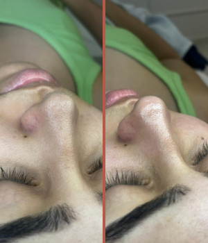 limpeza de pele, remoção de cravos do nariz