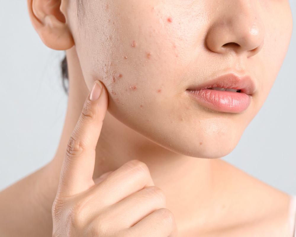 Manchas após o verão: como cuidar da pele e evitar marcas indesejadas